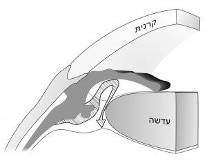 גלאוקומה של זוית סגורה איור