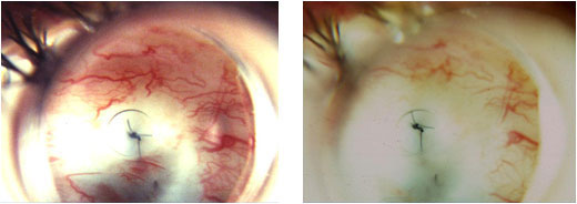 Volk Blumenthal Suturelysis Lens- blanching of blood vessels