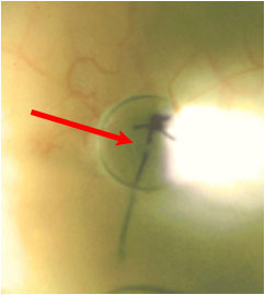 Volk Blumenthal Suturelysis Lens- suture is seen broken after a successful suturelysis