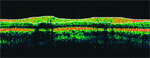 OCT: Optical Coherence Tomography