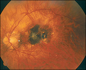 מרכז הראיה נראה מצולק ושחור (הכתם השחור במרכז התמונה). עין זאת איבדה את כל הראיה המרכזית בגלל ניוון מקולרי גילי (ניוון של מרכז המקולה).