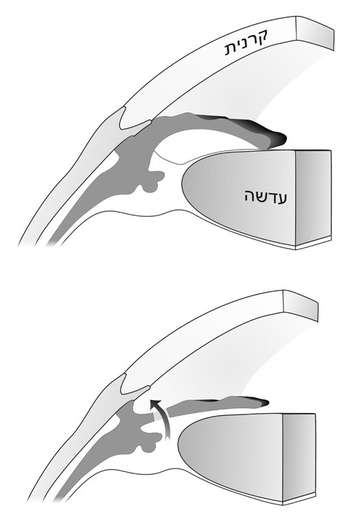 שחרור הלחץ בגלאוקומה של זוית-סגורה באמצעות טיפול לייזר