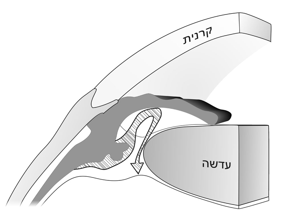 גלאוקומה של זוית סגורה איור