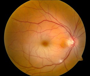 אוטם של עורק הרשתית המרכזי של העין
