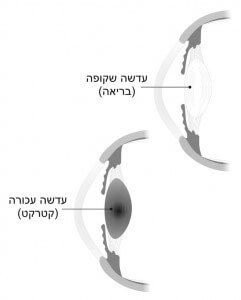 כיצד נראה קטרקט