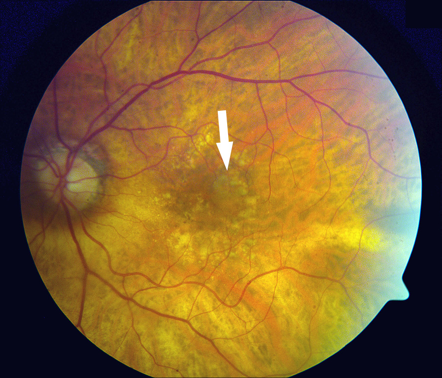 צילום של רשתית העין- החץ מצביע על איזור המקולה החולה