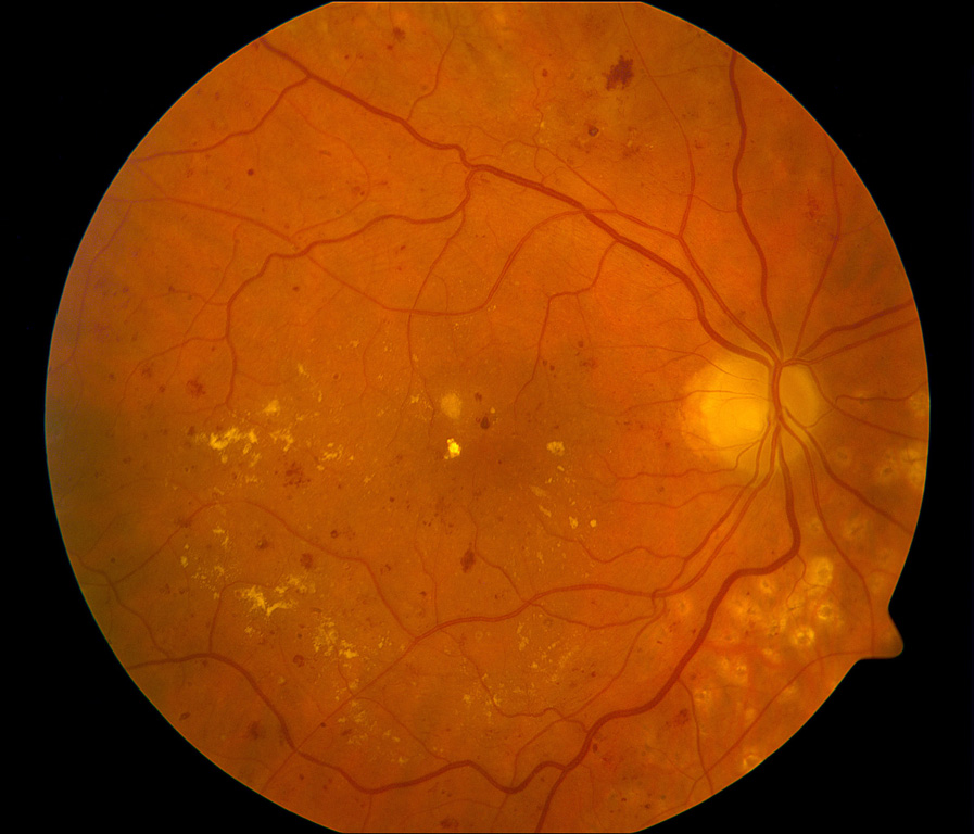 רשתית העין בחולה סכרת