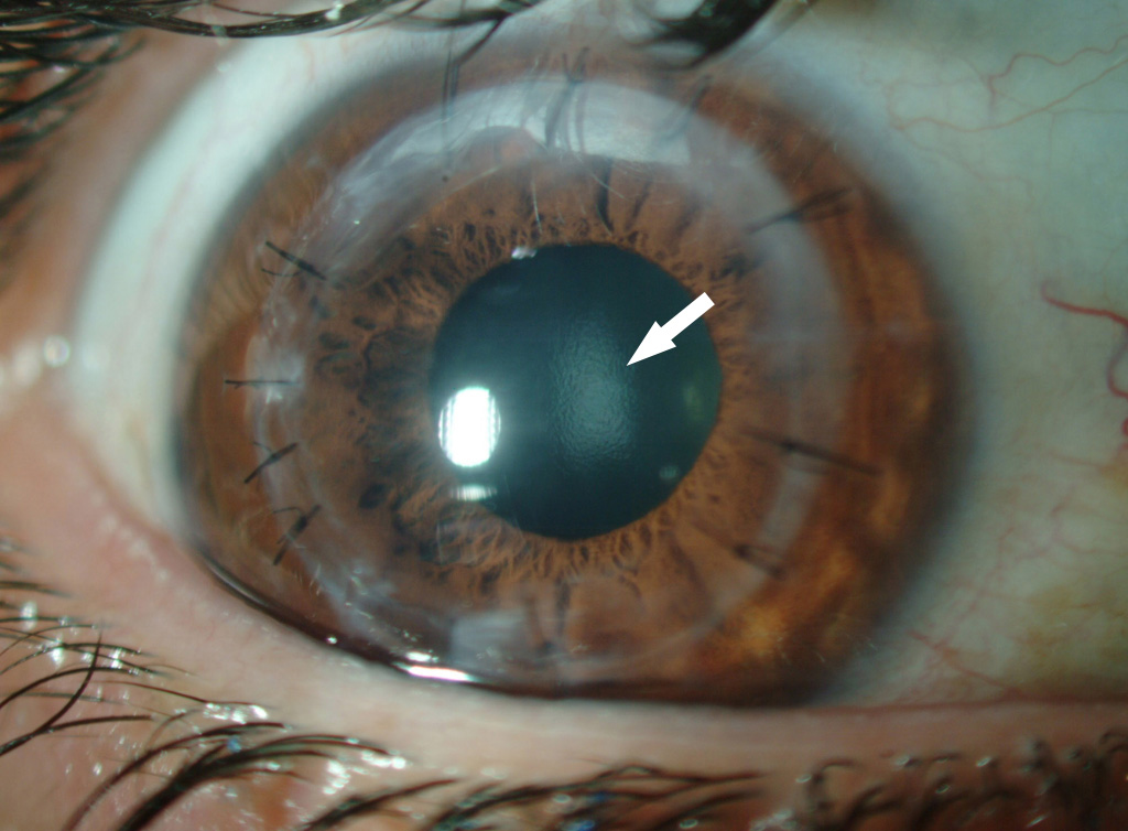 עין אחרי ניתוח השתלת קרנית מוצלח