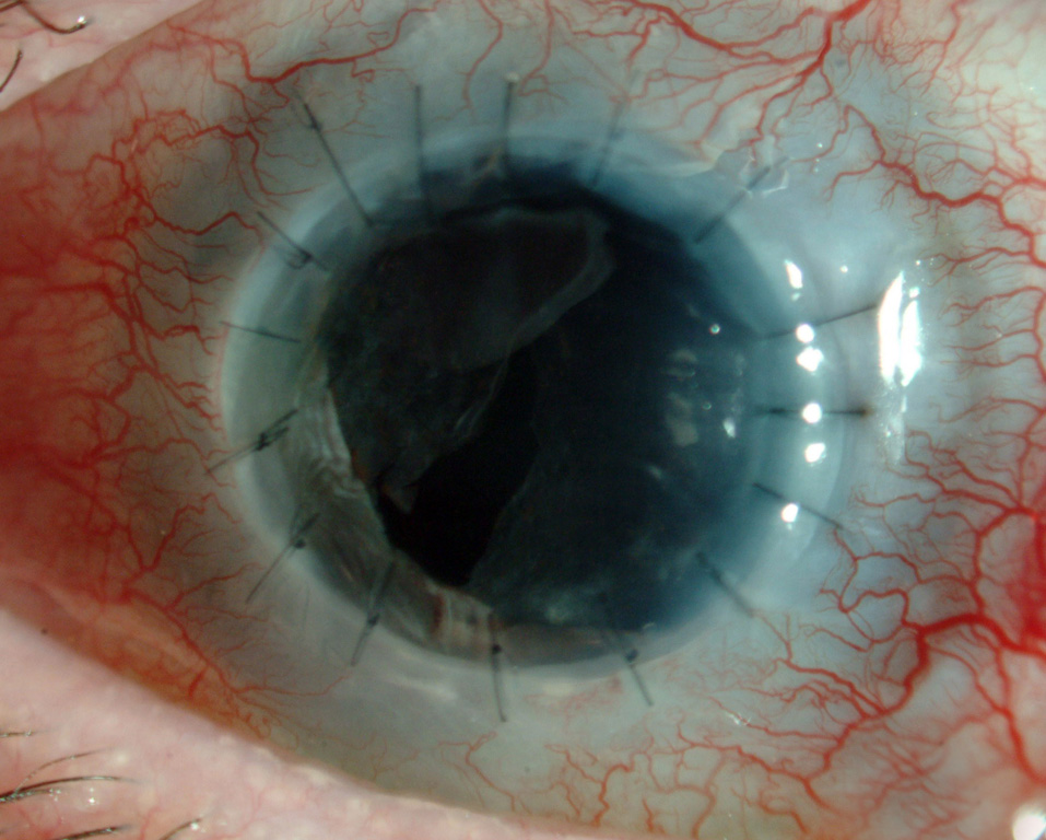 עין מודלקת אחרי ניתוח השתלת קרנית