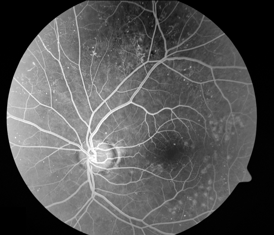 בצילום פלורסצאין זה ניתן לראות פגיעה סכרתית ברשתית וטיפול לייזר שעבר החולה בעין זו