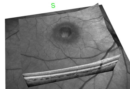 הדמייה תלת-מימדית של חור מקולרי (חור ברשתית הממוקם בדיוק במרכז הראיה)