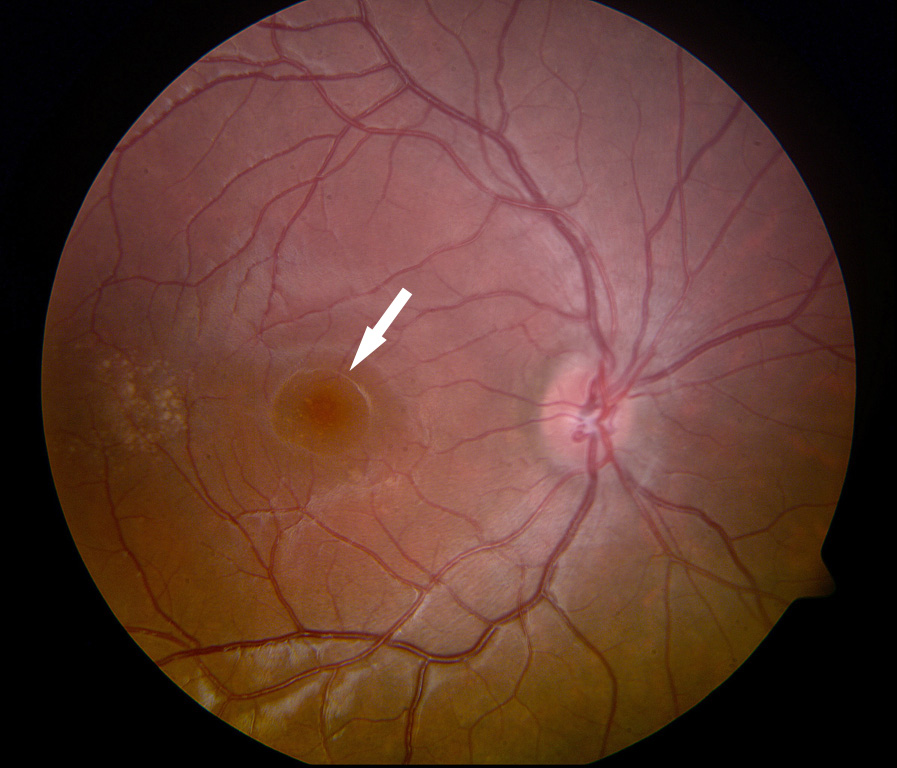תמונה של הקוטב האחורי של העין מדגימה חור מקולרי: חור ברשתית שמערב את מרכז הראיה (מסומן בחץ)תמונה של הקוטב האחורי של העין מדגימה חור מקולרי: חור ברשתית שמערב את מרכז הראיה (מסומן בחץ)