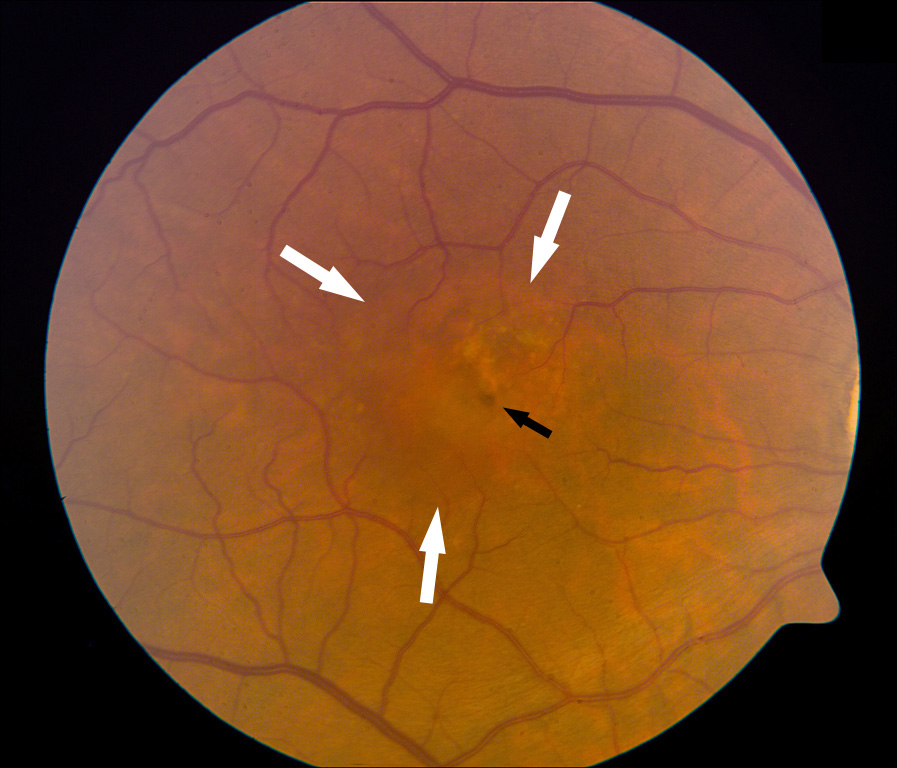 מחלה של מרכז הראיה המתבטאת בהרס של איזור המקולה, עקב נוזל וכלי-דם חדשים מתחת למקולה